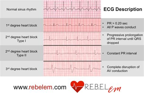 Bradycardia ECGs explained - Emergency Medicine Kenya Foundation