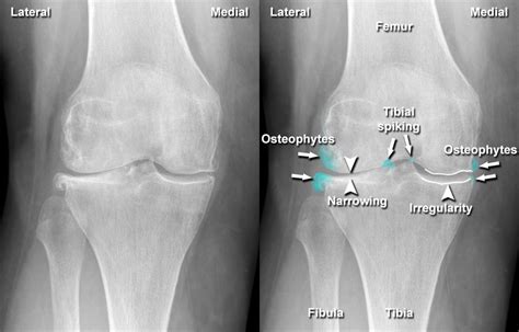 Imaging of Musculoskeletal Disorders - Osteoarthritis