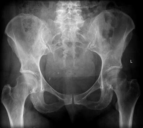 Femoral Neck Fractures – Core EM