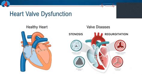 Improving the diagnosis of heart valve disease - Monash Institute of ...