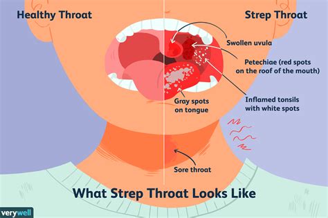 Everything You Need to Know About Strep Throat | Strep throat, Swollen ...