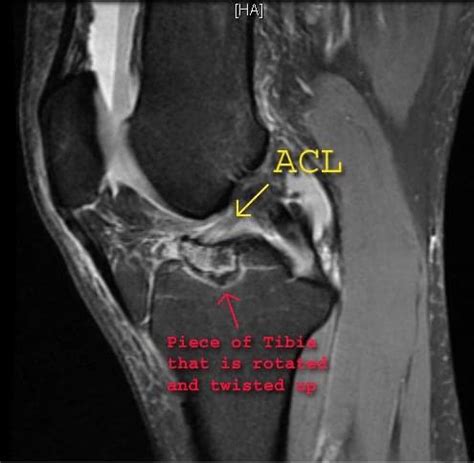 Follow-up MRI on tibial eminence fx X-rays. With Arrows : r/Radiology