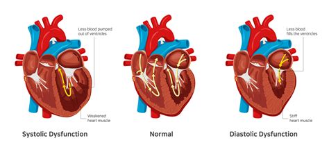 Know The Symptoms of Diastolic Dysfunction | Dr. Raghu