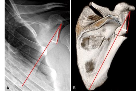 Comminuted Scapular Fracture