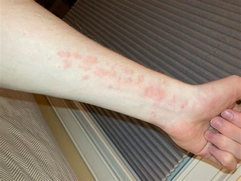 Does this look like brown tail moth rash? : r/Maine