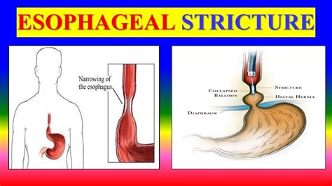 ESOPHAGEAL STRICTURE - meaning , causes , diagnostic , treatment and ...