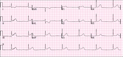 Dr. Smith's ECG Blog: Inferior STEMI with AV Block, Cardiogenic Shock ...