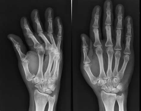 BENNETT’S FRACTURE | Buyxraysonline