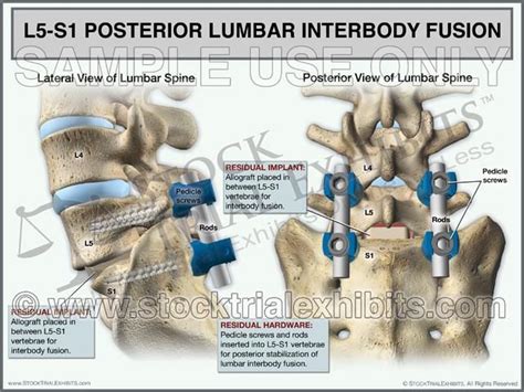 Posterolateral Fusion Surgery