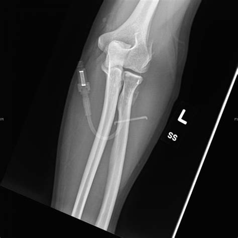 Lateral Epicondyle Fracture - JETem