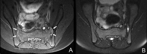 Sacroiliitis without bone marrow edema. Axial MRI images of the ...