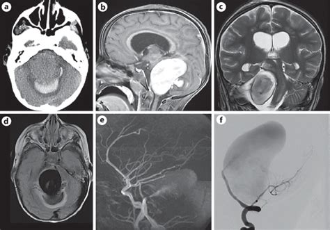 CT scan in a preschool child presenting with acute headache and ...