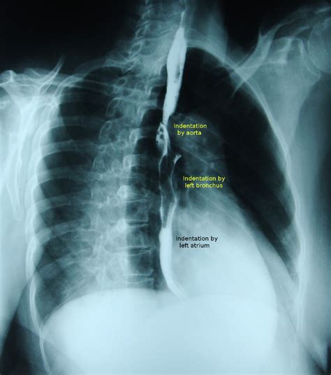 Stenosis: Stenosis Esophagus