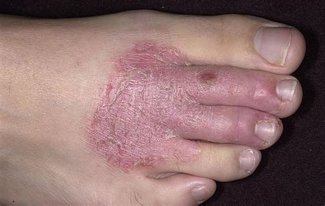 What are the Causes and Symptoms of Eczema?