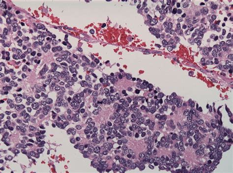 The four main types of rosettes in pathology | Pathology Student