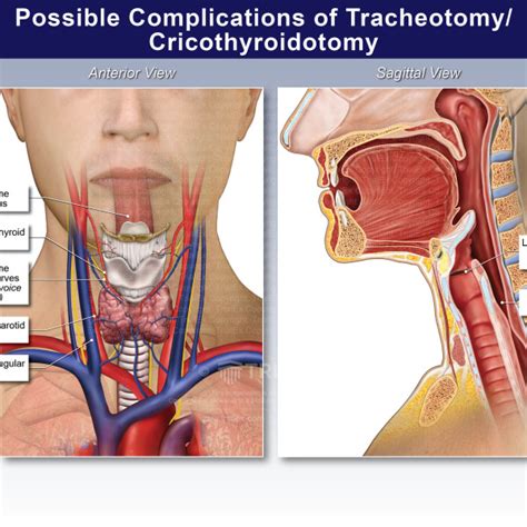 Possible Complications of Tracheotomy/ Cricothyroidotomy ...