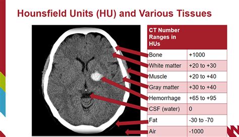 Approaching a Non-Contrast Head CT Scan: Excluding Intracranial ...