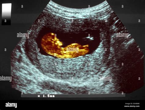 NUCHAL TRANSLUCENCY MEASUREMENT Stock Photo - Alamy