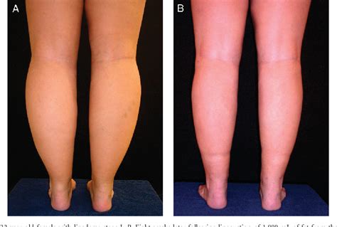 Lipedema | Semantic Scholar