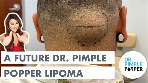 A Future Dr. Pimple Popper Lipoma - Recently Added