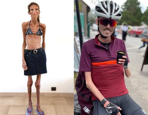 Skinniest Person: Meet 10 World's Thinnest People Alive 2024 - The ...