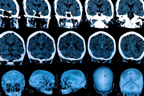 What Brain Abscess Treatment Options Are Available for Me? - R3 Wound ...