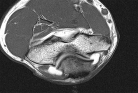 How to Read a Hip Mri Arthrogram - Wilder Ateres