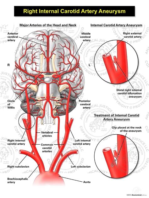 Anatomy Arteries In Neck Carotid Artery Anatomy Function Disease ...