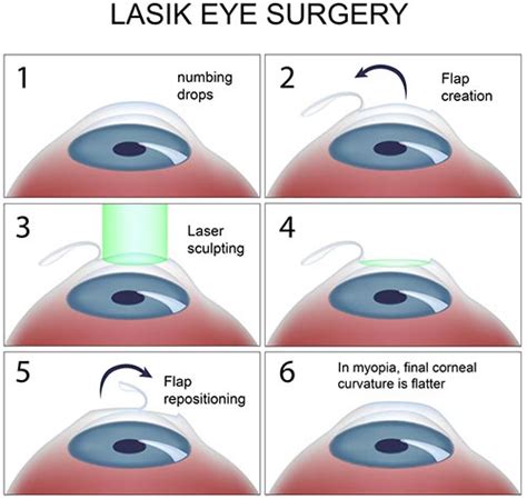 lasik surgery cost south africa 2020 ...