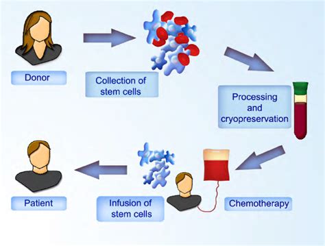 Allogeneic stem cell transplantation. Hematopoietic stem cells are ...