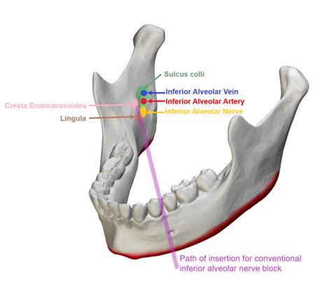 [Figure, Conventional inferior alveolar nerve block...] - StatPearls ...