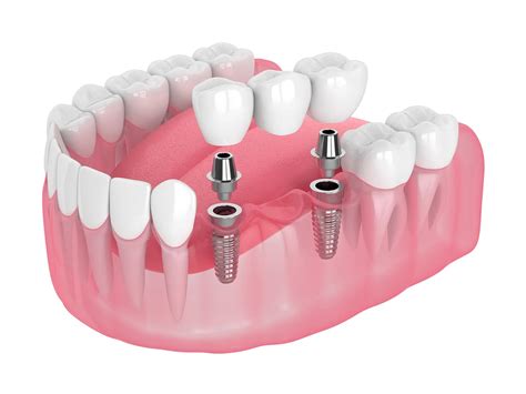 Dental Bridge Abutment