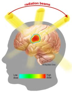 Stereotactic Radiosurgery (SRS) - Asian American Radiation & Oncology