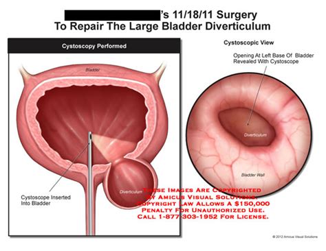 AMICUS Illustration of amicus,surgery,bladder,diverticulum,cystoscopy ...