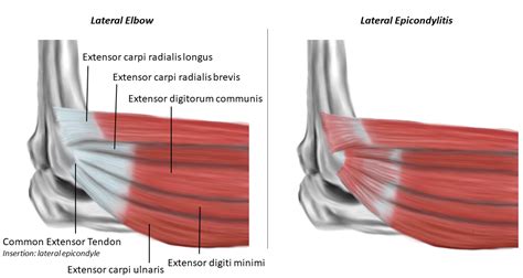 Epicondylitis - TeachMeSurgery