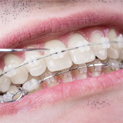 Ceramic Braces: Pros and Cons - Children's Braces and Dentistry