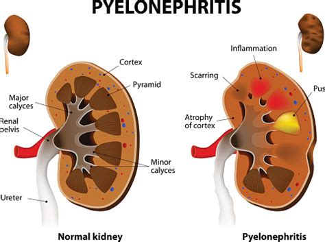 Ilustración de Pielonefritis y más Vectores Libres de Derechos de ...