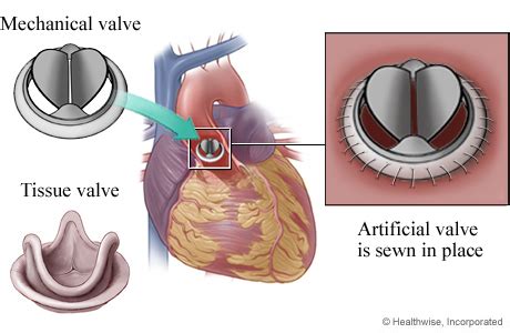 Mitral Valve Replacement Surgery: Your Questions Answered