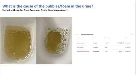 Bubbles In Pee Chlamydia at Pamela Mann blog