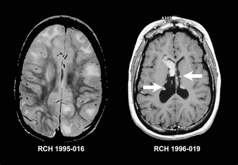 Common Warning Signs of a Brain Tumor | Page 9 | Things Health