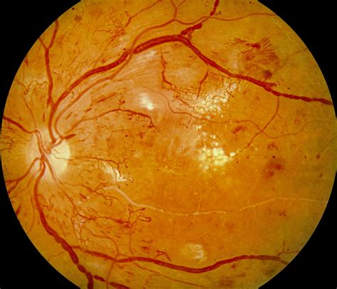 Panretinal Photocoagulation Significantly Reduces Macular Pigment ...