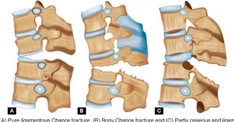 Figure 5 from Missed Chance Fracture of Lumbar Vertebra presenting as ...