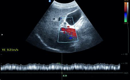 Normal Portal Vein Flow Ultrasound