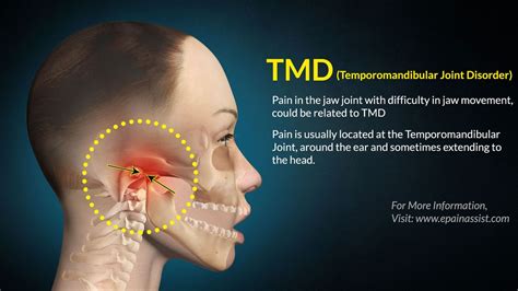 الاضطرابات المفصلية الصدغية (TMJ & TMD): نظرة عامة | 2024