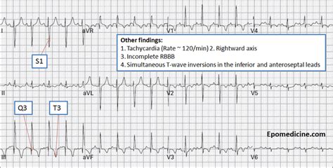 Pulmonary Embolism