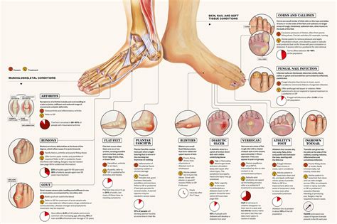 Types Of Foot Problems - Design Talk