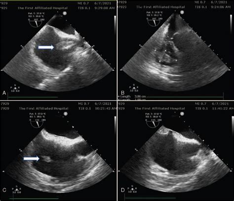 Circulation collapse caused by intracardiac thrombosis assoc... : Medicine