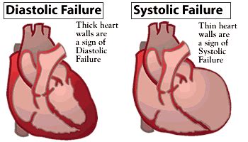 Heart Failure, Systolic