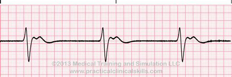 Idioventricular Rhythm ECG Interpretation with Sample Strip