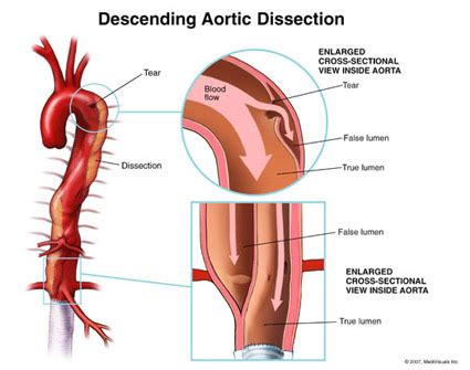 Image Gallery dissection aortic